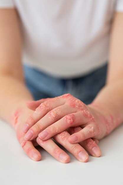 Как правильно лечить дерматит: основные методы
