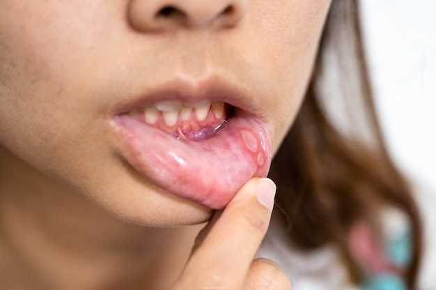 10 способов быстро вылечить герпес во рту
