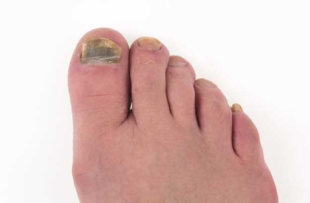 Опасности грибка ногтя